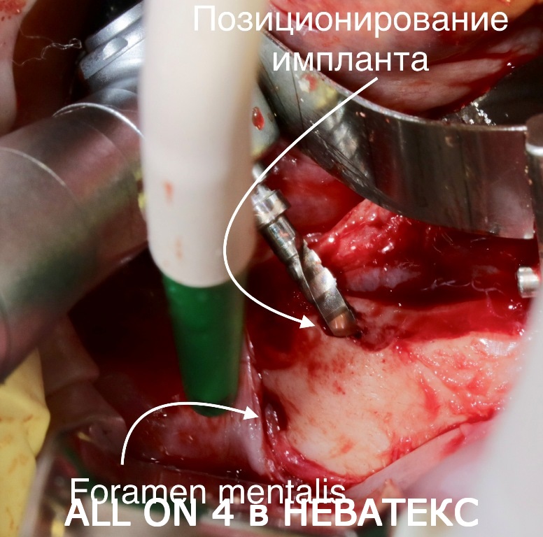 Установка несъемного протеза на имплантах несъемный протез на имплантах